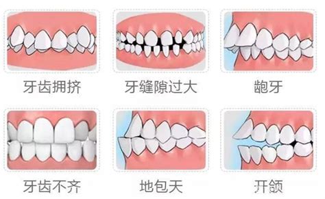 大门牙|门牙很大怎么办？